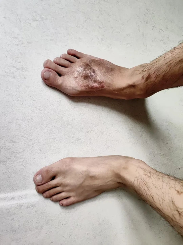 3D打印技术助力跖骨修复，王先生开启自由行走的全新人生！