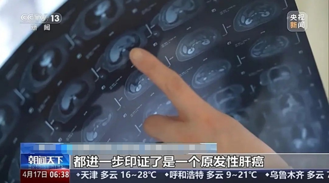 【关注】双腿发痒以为是过敏,没想到竟是肝癌……(图2) 2.jpg