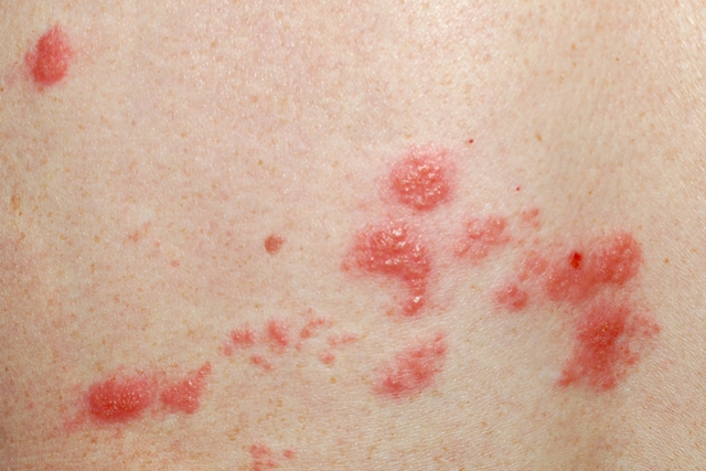 【当心】偏瘫女子左侧颈肩部、左上臂长满一簇簇水疱……