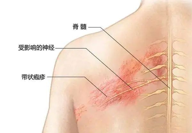 【当心】偏瘫女子左侧颈肩部、左上臂长满一簇簇水疱……(图4) 4.jpg