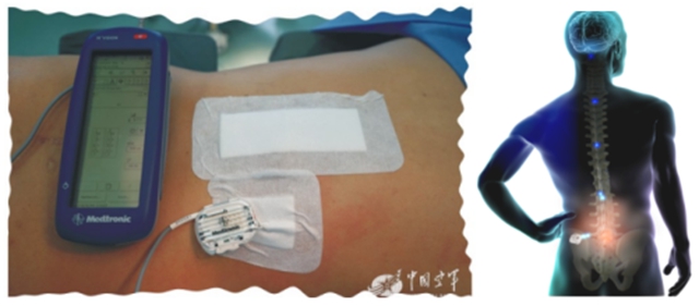 【当心】偏瘫女子左侧颈肩部、左上臂长满一簇簇水疱……(图5) 5.jpg