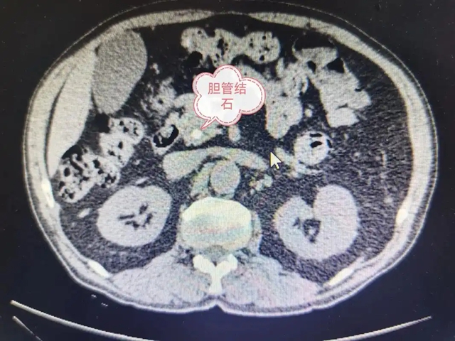 【警惕】感染性休克，藏在胆总管里的“定时炸弹”