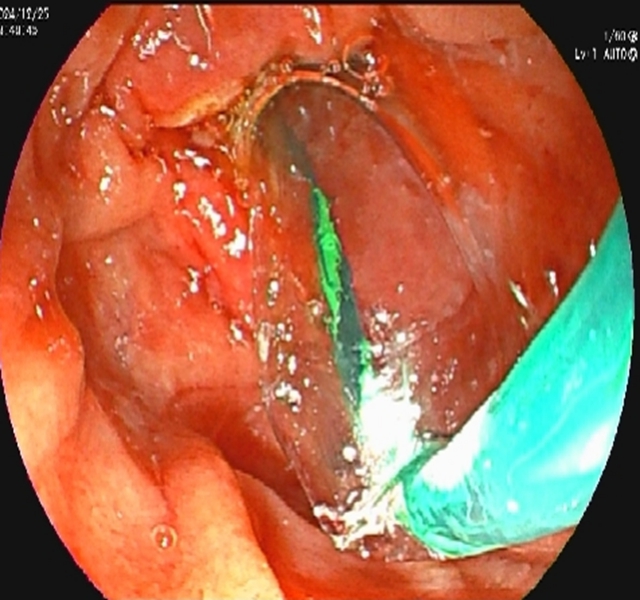 【警惕】感染性休克,藏在胆总管里的“定时炸弹”(图6) 6.jpg