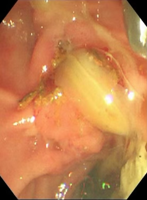 【警惕】感染性休克,藏在胆总管里的“定时炸弹”(图5) 5.jpg