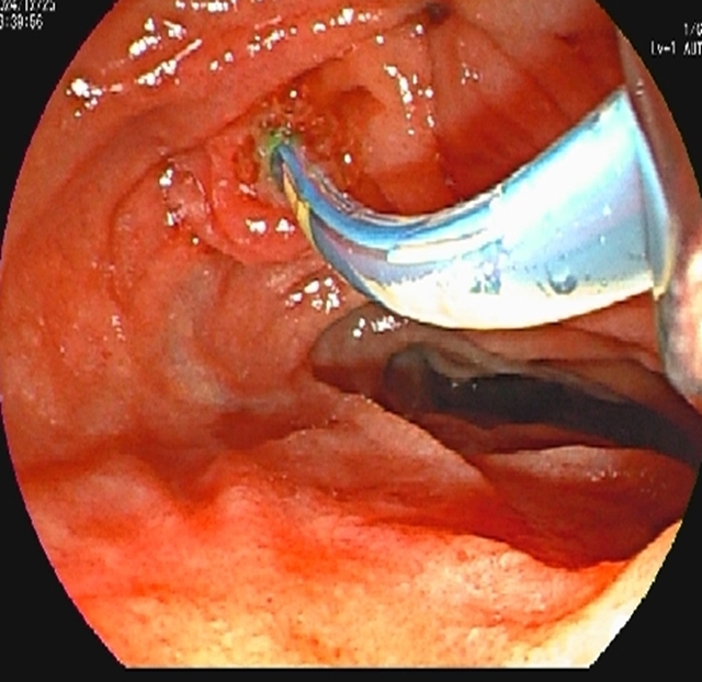 【警惕】感染性休克,藏在胆总管里的“定时炸弹”(图4) 4.jpg