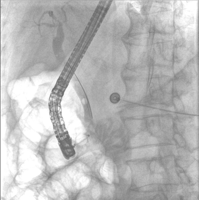 【警惕】感染性休克,藏在胆总管里的“定时炸弹”(图7) 7.jpg