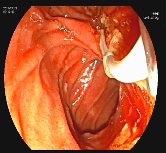 【警惕】感染性休克,藏在胆总管里的“定时炸弹”(图8) 8.jpg