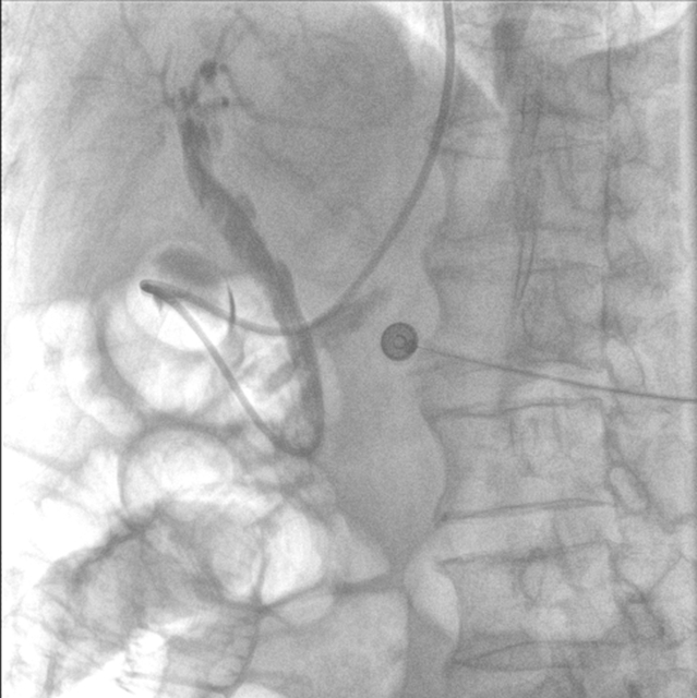 【警惕】感染性休克,藏在胆总管里的“定时炸弹”(图10) 10.jpg