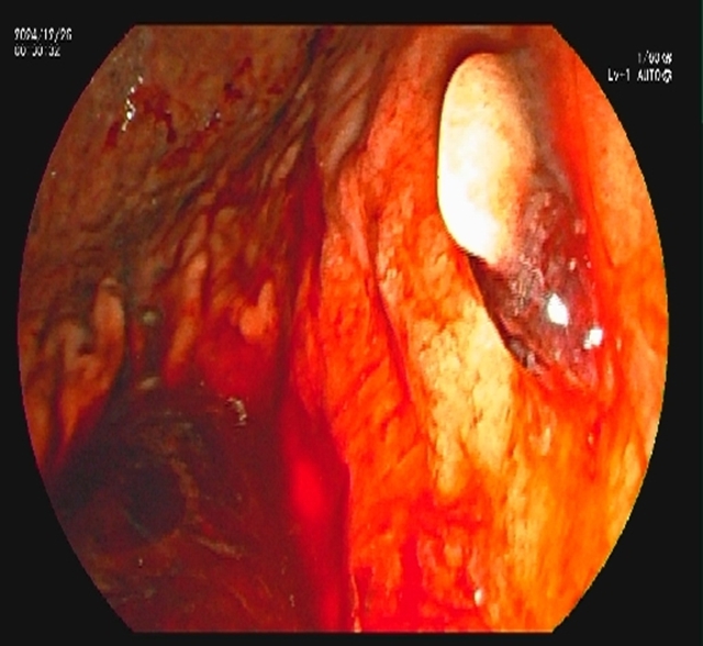 【警惕】感染性休克,藏在胆总管里的“定时炸弹”(图9) 9.jpg