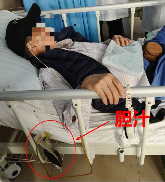 【警惕】感染性休克,藏在胆总管里的“定时炸弹”(图11) 11.jpg