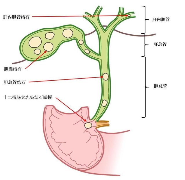 【警惕】感染性休克,藏在胆总管里的“定时炸弹”(图13) 13.jpg