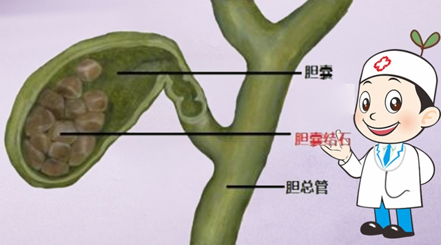 【警惕】感染性休克,藏在胆总管里的“定时炸弹”(图15) 15.jpg