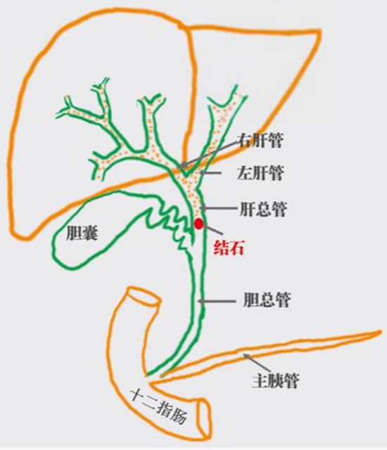【警惕】感染性休克,藏在胆总管里的“定时炸弹”(图14) 14.jpg