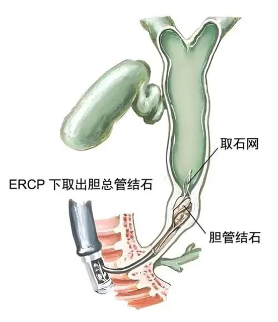 【警惕】感染性休克,藏在胆总管里的“定时炸弹”(图18) 18.jpg