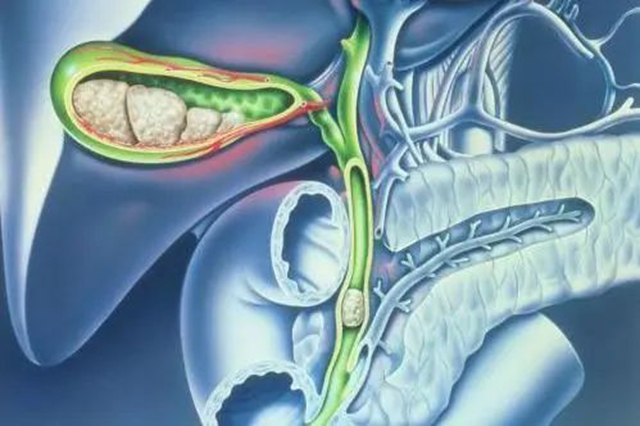 【警惕】感染性休克,藏在胆总管里的“定时炸弹”(图17) 17.jpg