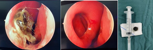 潜伏数10年！鼻腔取出“古董级”异物