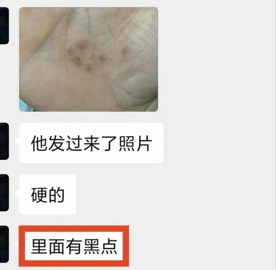 泸州男子手上长出……