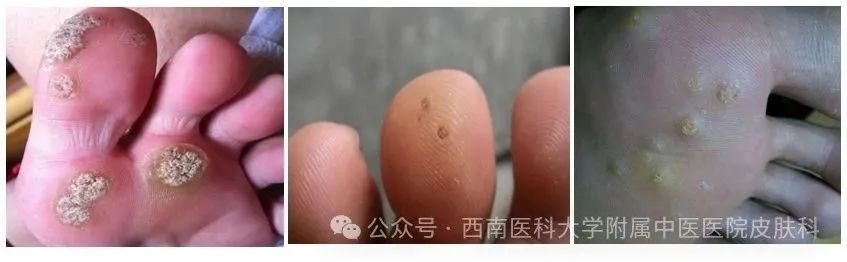 泸州男子手上长出……(图3) 3.jpg