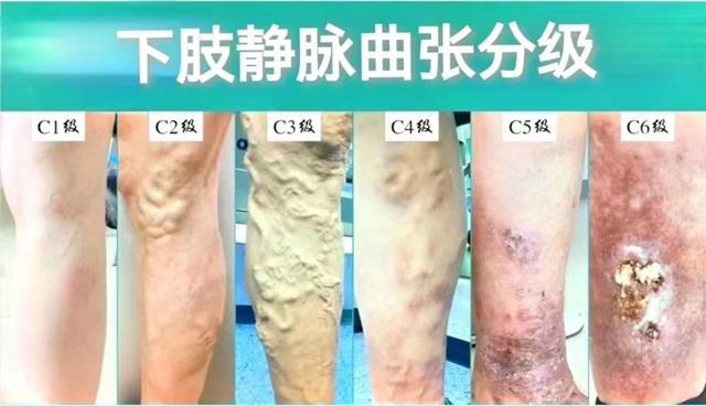 术治好泸州阿姨20年的“蚯蚓腿”，创伤小、恢复快