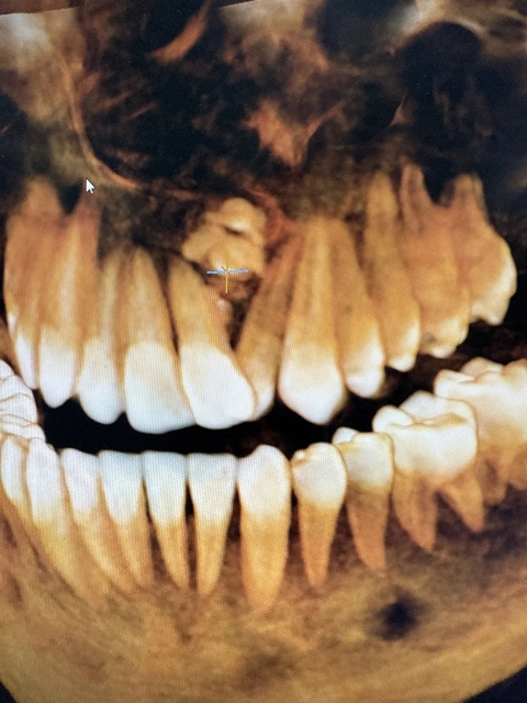 【震惊】什么!牙齿也会长“肿瘤”?(图2) 2.jpg