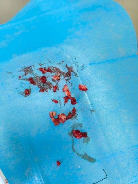 【震惊】什么!牙齿也会长“肿瘤”?(图3) 3.jpg