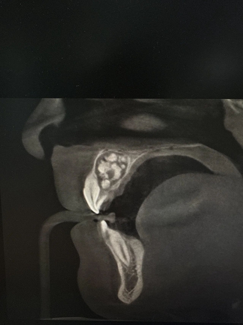 【震惊】什么!牙齿也会长“肿瘤”?(图4) 4.jpg