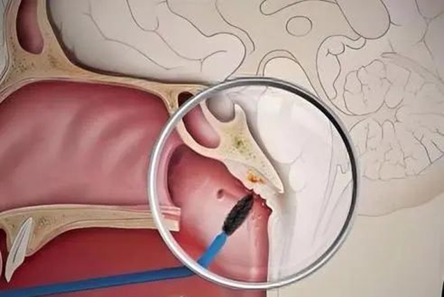 鼻咽癌，临床治愈！