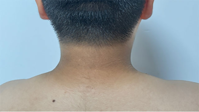 脖子黑得像没洗干净？别大意，这可能是求救信号！