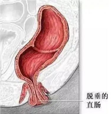 惊!21岁小伙便秘5年拉出10厘米肠子,还想手动塞回去?!(图2) 拉2.jpg