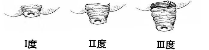 惊!21岁小伙便秘5年拉出10厘米肠子,还想手动塞回去?!(图4) 拉4.jpg