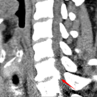 【关注】腿软打颤……男子差点瘫痪!(图2) 瘫痪2.png