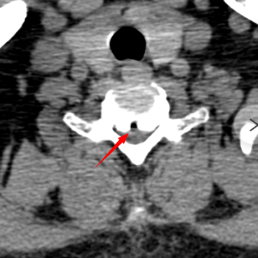 【关注】腿软打颤……男子差点瘫痪!(图3) 瘫痪3.png