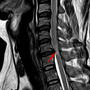 【关注】腿软打颤……男子差点瘫痪!(图4) 瘫痪4.png