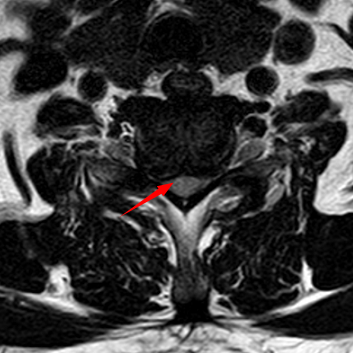 【关注】腿软打颤……男子差点瘫痪!(图5) 瘫痪5.png