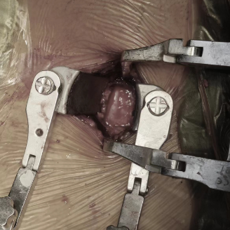 【关注】腿软打颤……男子差点瘫痪!(图6) 瘫痪6.png