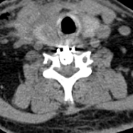 【关注】腿软打颤……男子差点瘫痪!(图7) 瘫痪7.png