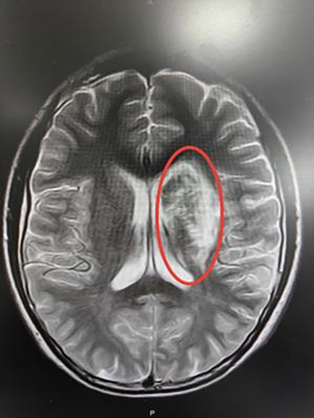 【警惕】12岁男孩脑梗死，原因竟是……