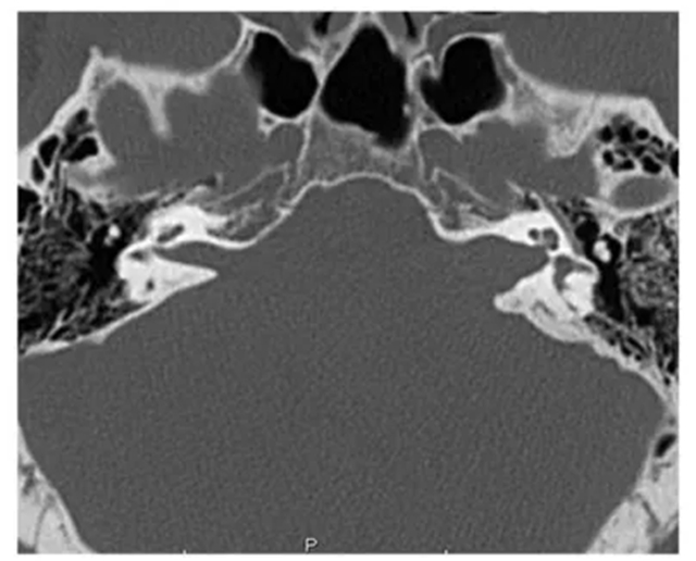 【科普】别把耳鸣当小事!这些信号可能是听神经瘤警报(图5) 5.jpg