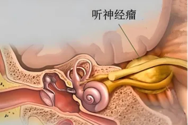【科普】别把耳鸣当小事!这些信号可能是听神经瘤警报(图2) 2.jpg