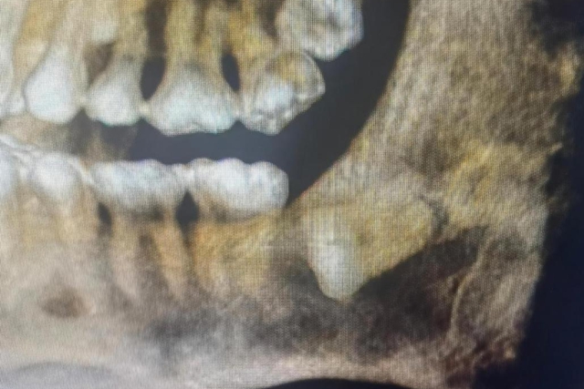 1米8帅小伙拔智齿,医生竟没看到牙!一查牙龈里藏了颗 “定时炸弹”(图2) 2.jpg