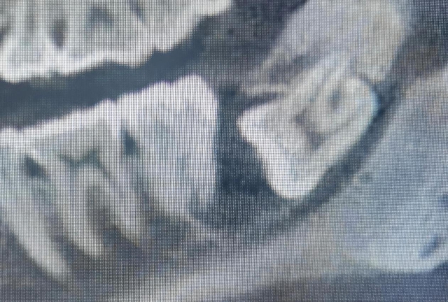 1米8帅小伙拔智齿,医生竟没看到牙!一查牙龈里藏了颗 “定时炸弹”(图3) 3.jpg