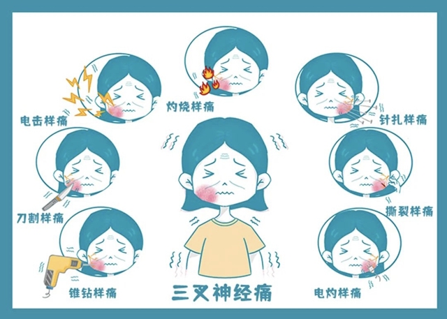 三叉神经痛不用忍!合江县中医医院微创技术精准应对(图1) 叉1.jpg