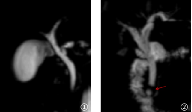 胆结石、胆管问题怎么查?这场 “体内直播” 告诉你(图1) 石1.jpg
