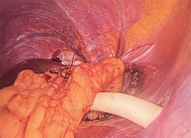 泸州1男1女术后半年再复发(图3) 3.jpg