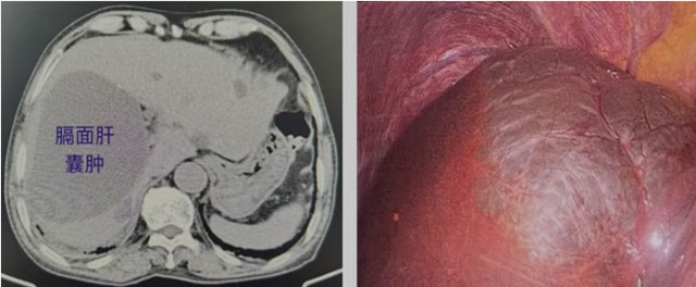 泸州1男1女术后半年再复发(图1) 1.jpg