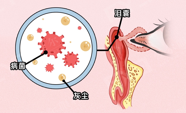 眼屎突然变多,是眼睛出问题了吗?(图3) 3.jpg