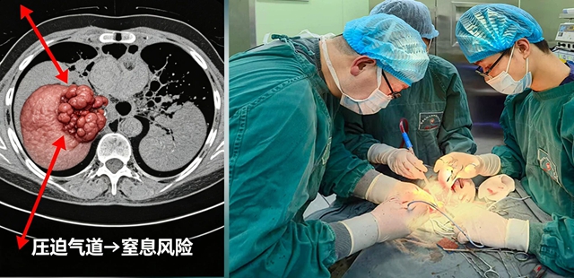 脓毒症!泸州男子颈部两次开刀排脓(图2) 刀2.jpg