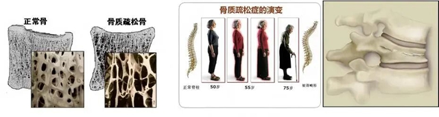 打个喷嚏就骨折?这项微创“打针”手术,帮骨折老人重新行走(图1) 人1.jpg