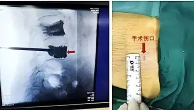 打个喷嚏就骨折?这项微创“打针”手术,帮骨折老人重新行走(图2) 人2.jpg