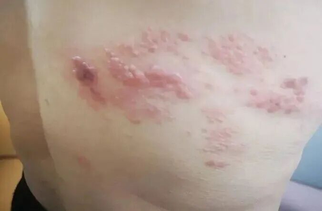 死不了但折磨人!这种常见病的后遗症,真的让人痛不欲生……(图6) 6.jpg